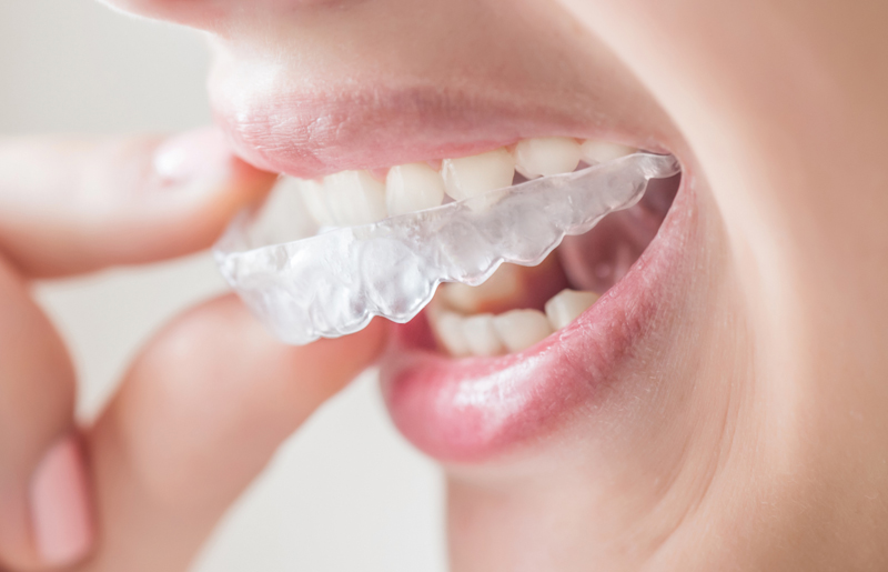 What are the advantages of Invisalign?