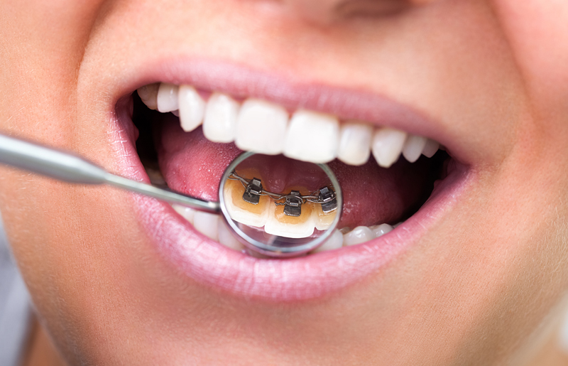 How are lingual braces fitted?